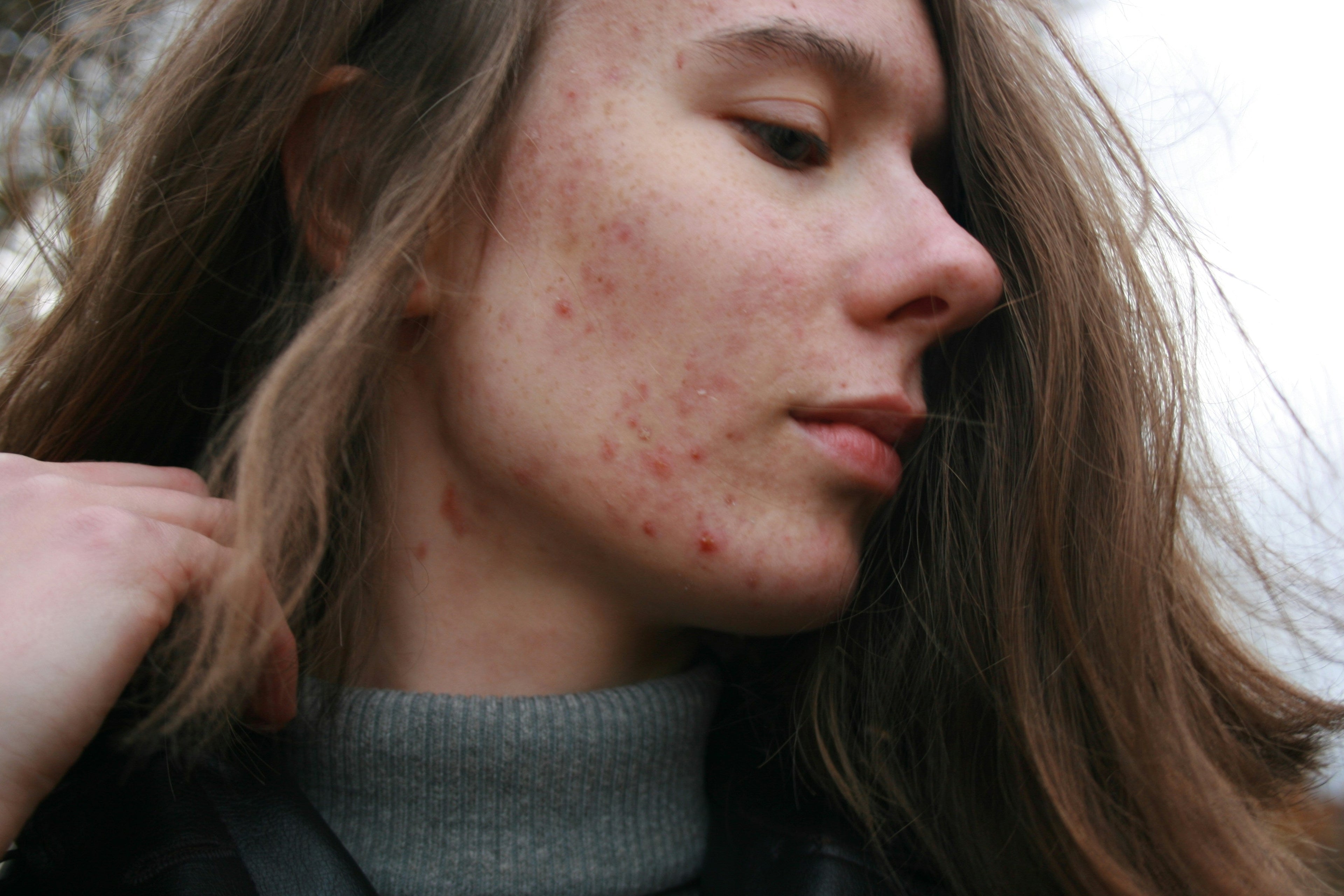 Acne-Blemishes 21stCY