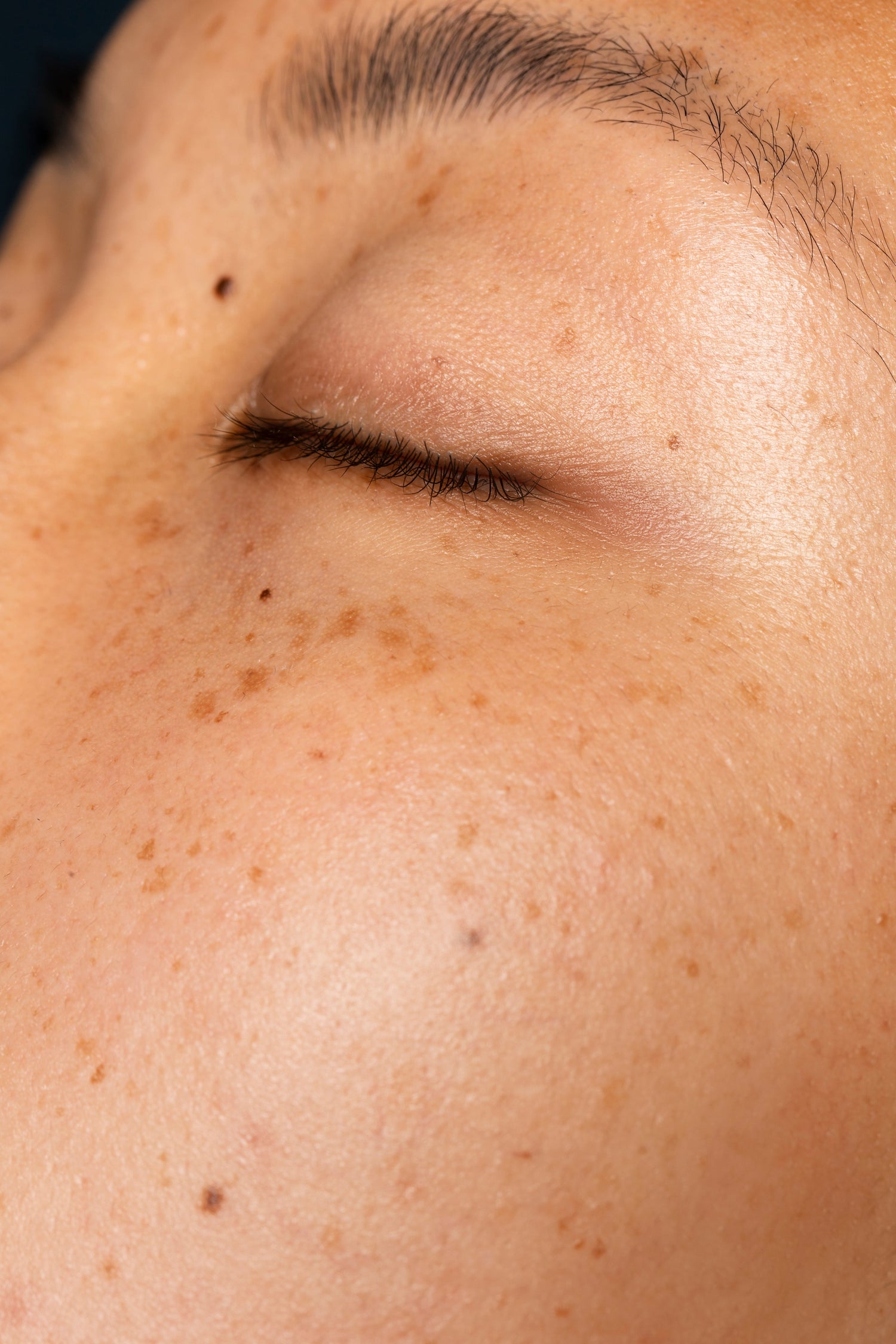 Hyperpigmentation 21stCY