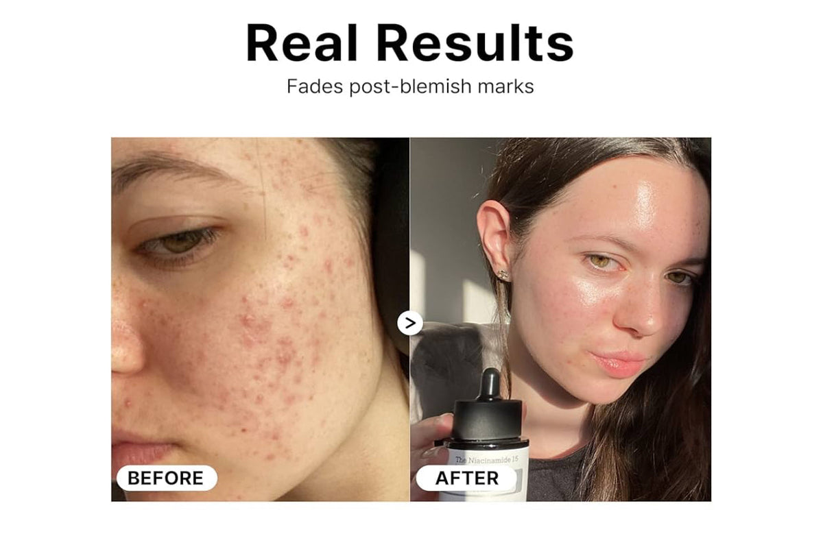 COSRX Niacinamide 15% Face Serum, Minimizing Pores & Sebums, Blemish Treatments for Discoloration, Dark Spots, Enlarged Pores, Anti-aging, 20 ml, Cosrx